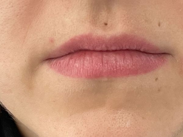 Before-Injection des lèvres