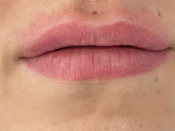 After-Injection des lèvres