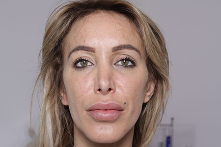 After-Injection de Botox