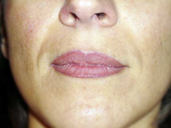 Before-Lèvres avec acide hyaluronique