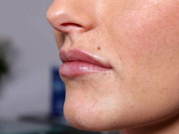 After-Lèvres avec acide hyaluronique