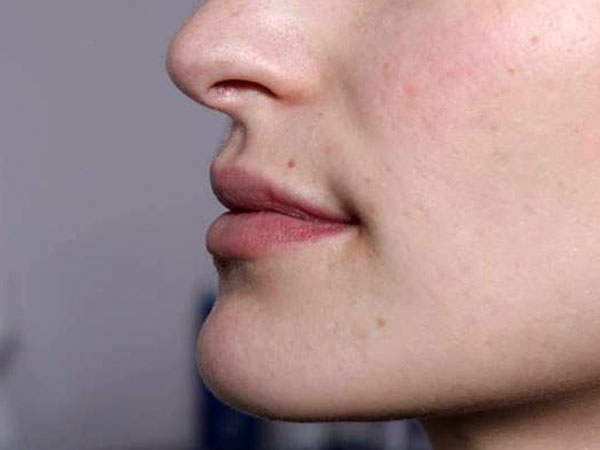 Before- Lèvres avec acide hyaluronique