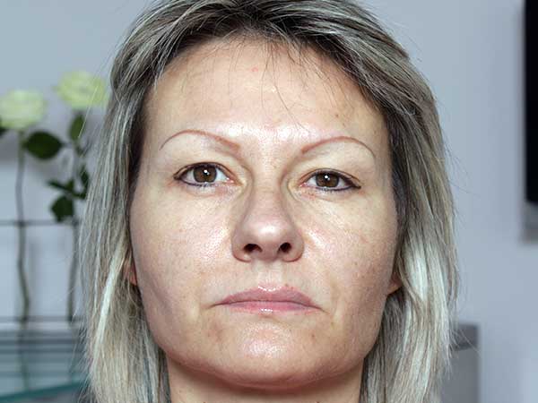 After-Injection de botox