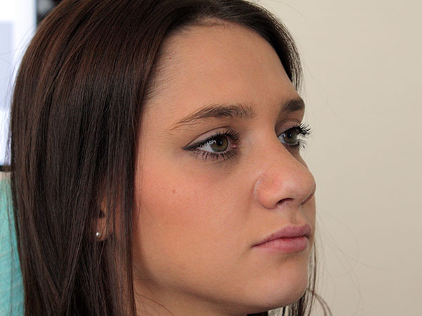 After-Rhinoplastie chirurgicale
