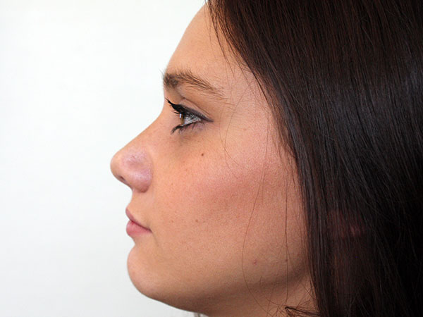 After-Rhinoplastie chirurgicale