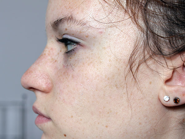 After-Rhinoplastie Chirurgicale