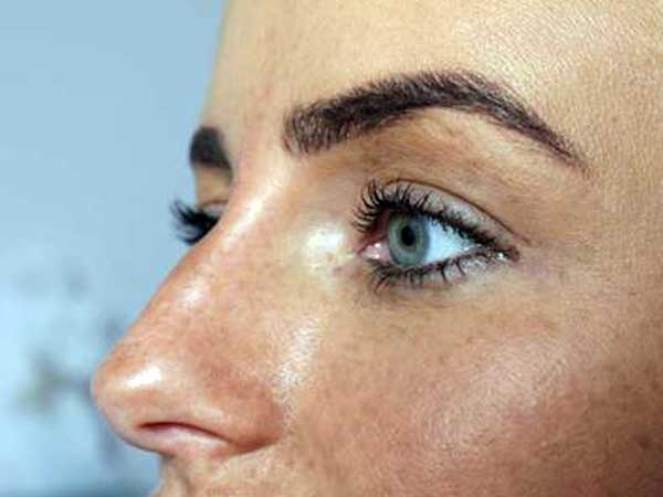 After-Rhinoplastie médicale - Injection d'acide hyaluronique